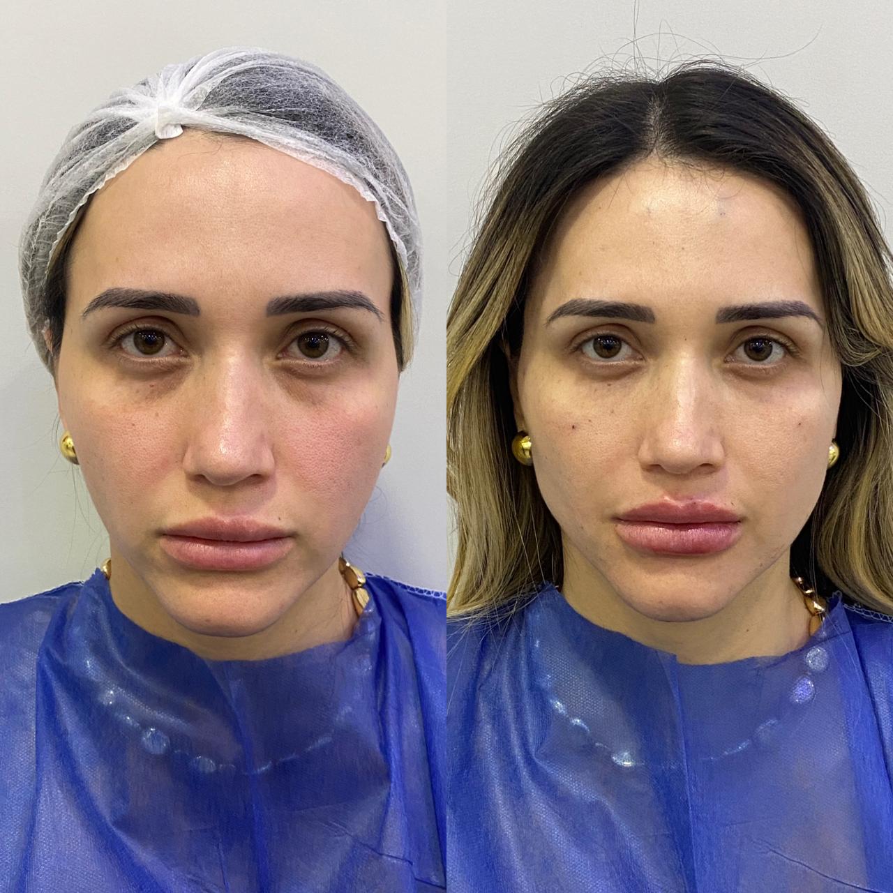 Preenchimento Labial