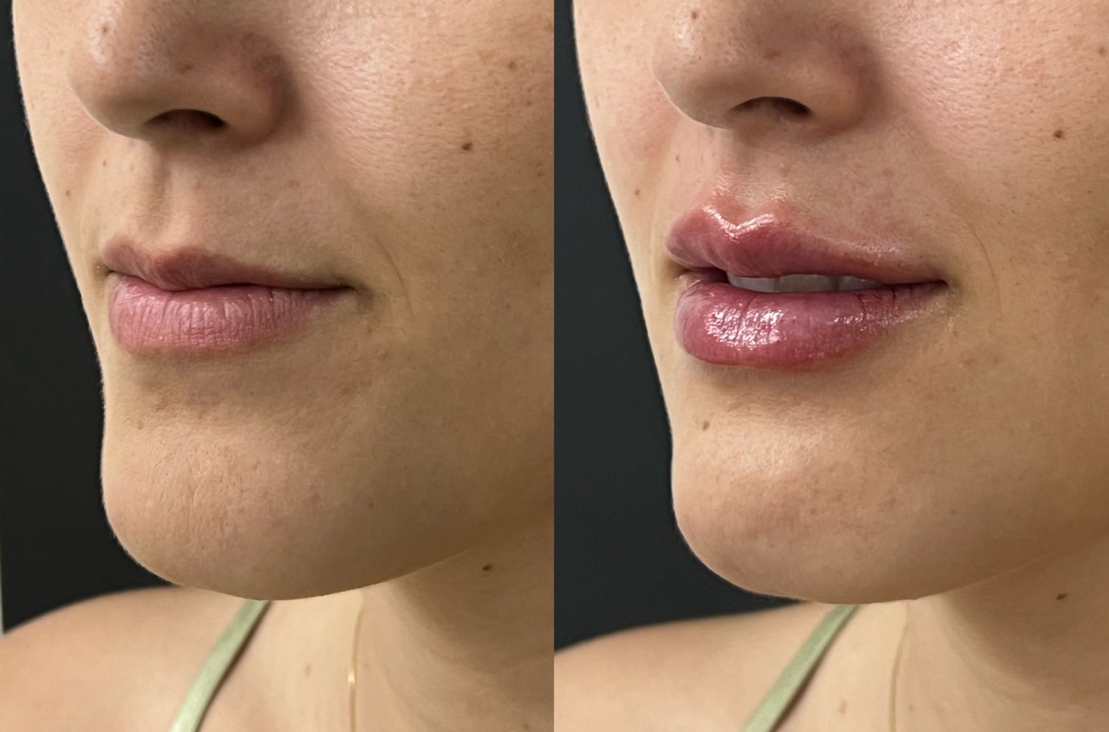 Preenchimento Labial