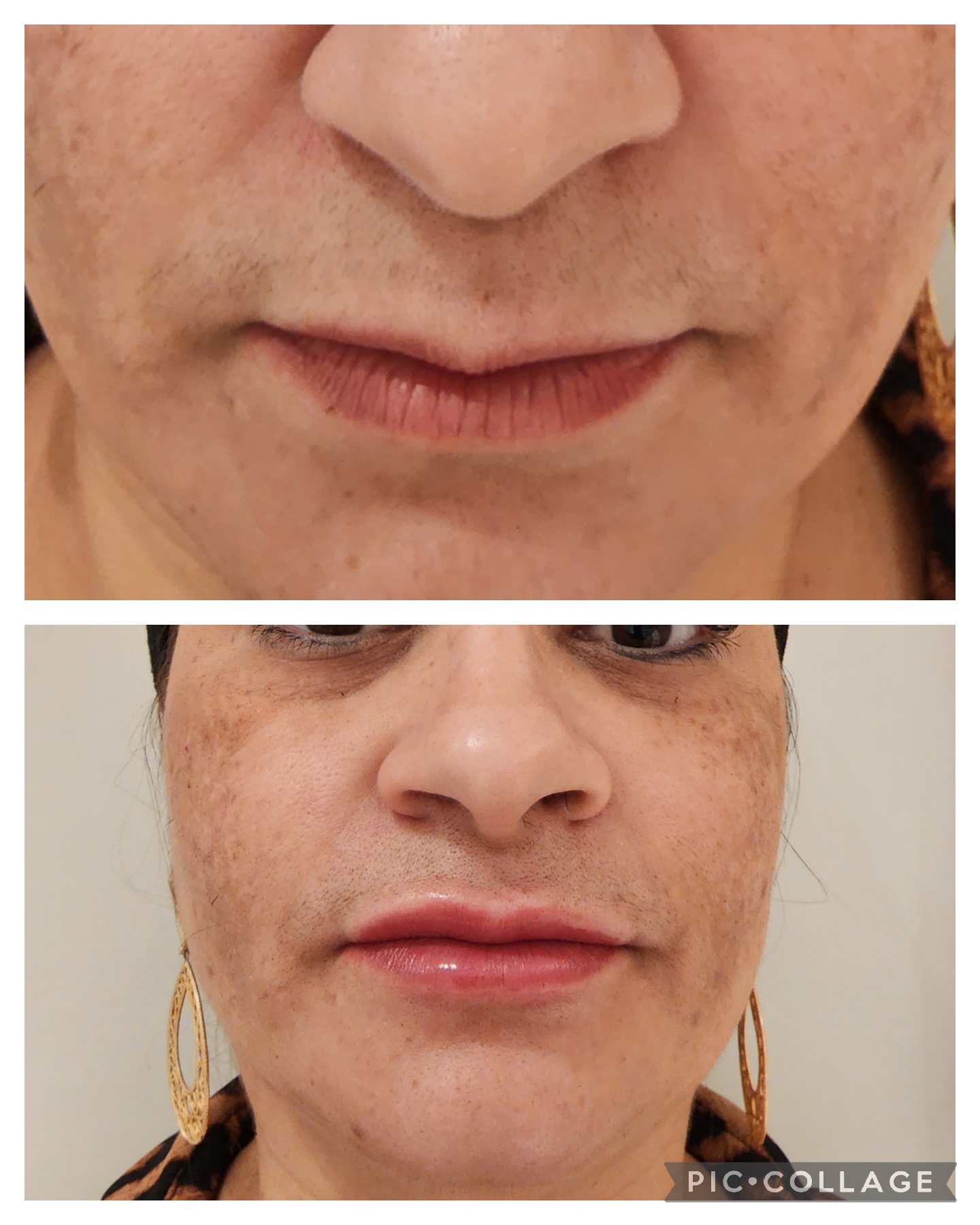 Preenchimento Labial