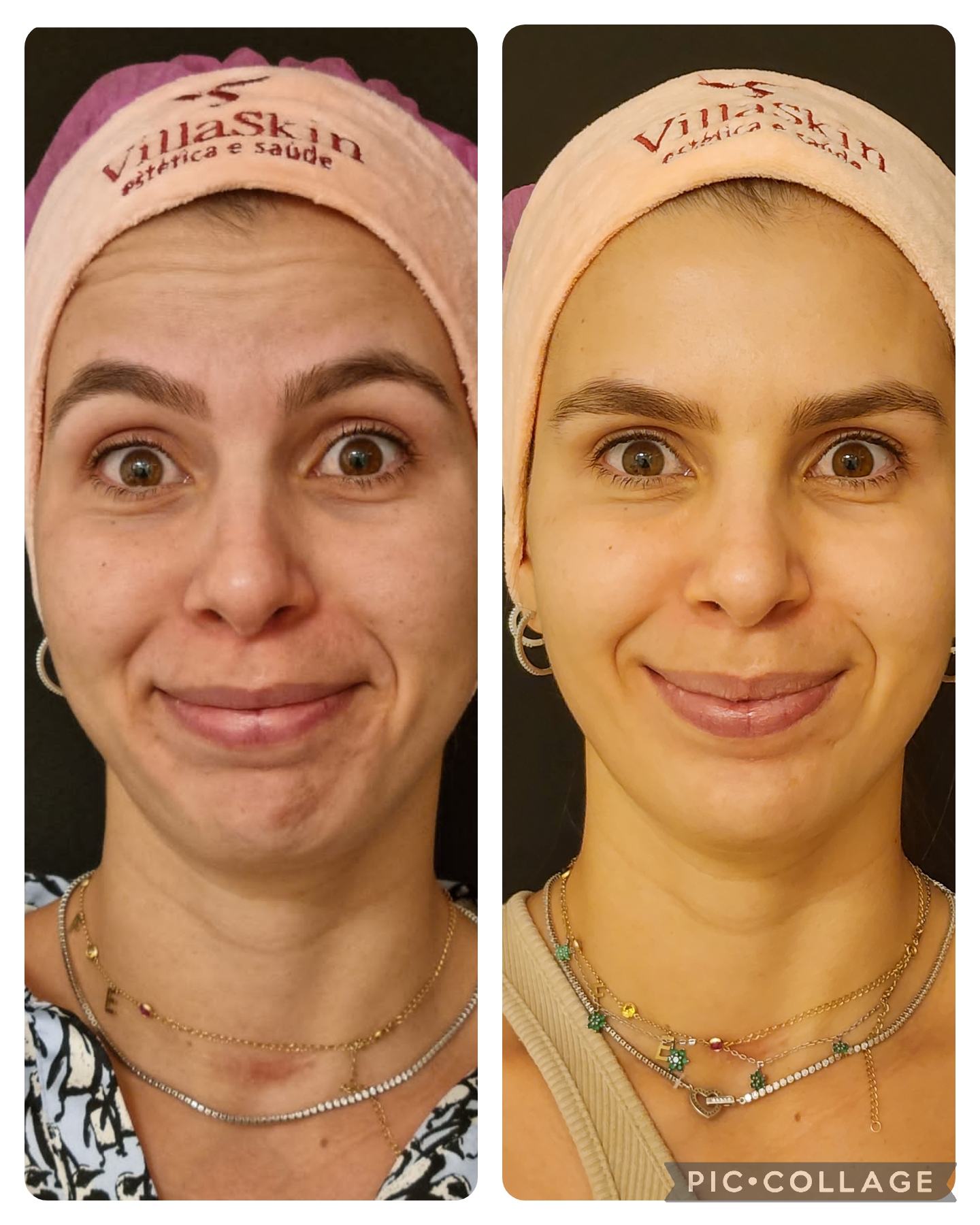 Toxina Botulínica