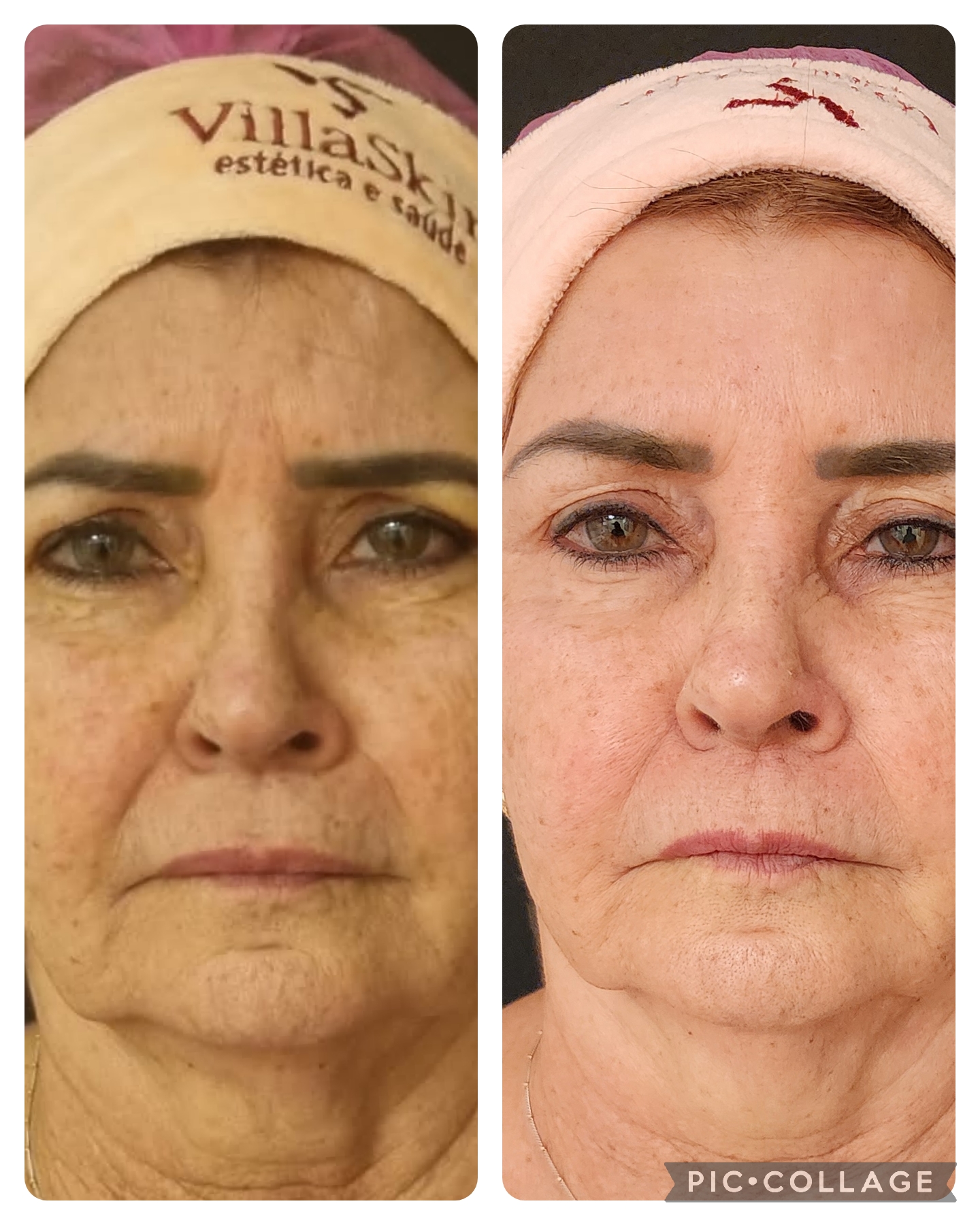 Toxina Botulínica