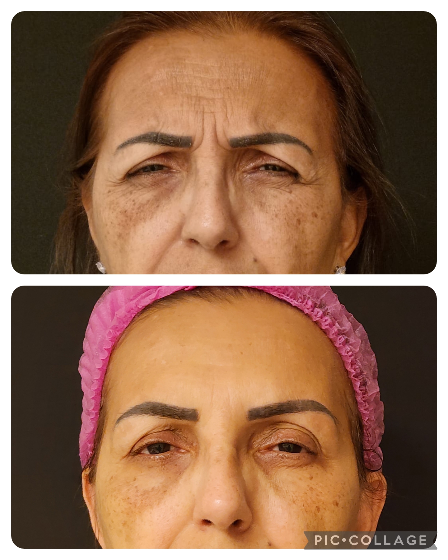 Toxina Botulínica