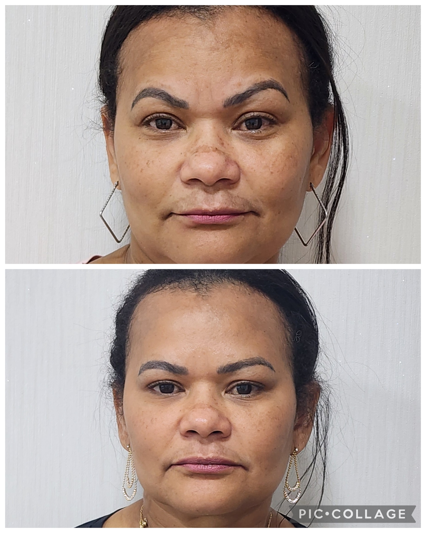 Toxina Botulínica