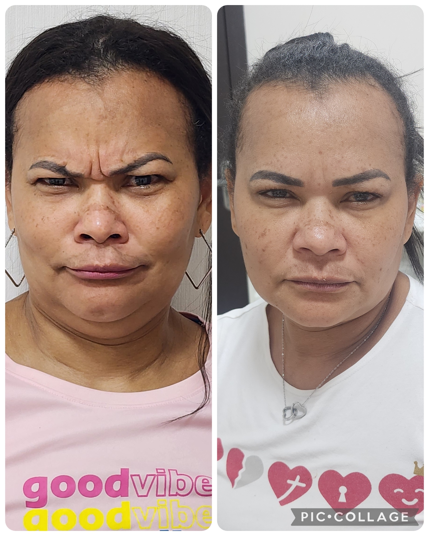 Toxina Botulínica