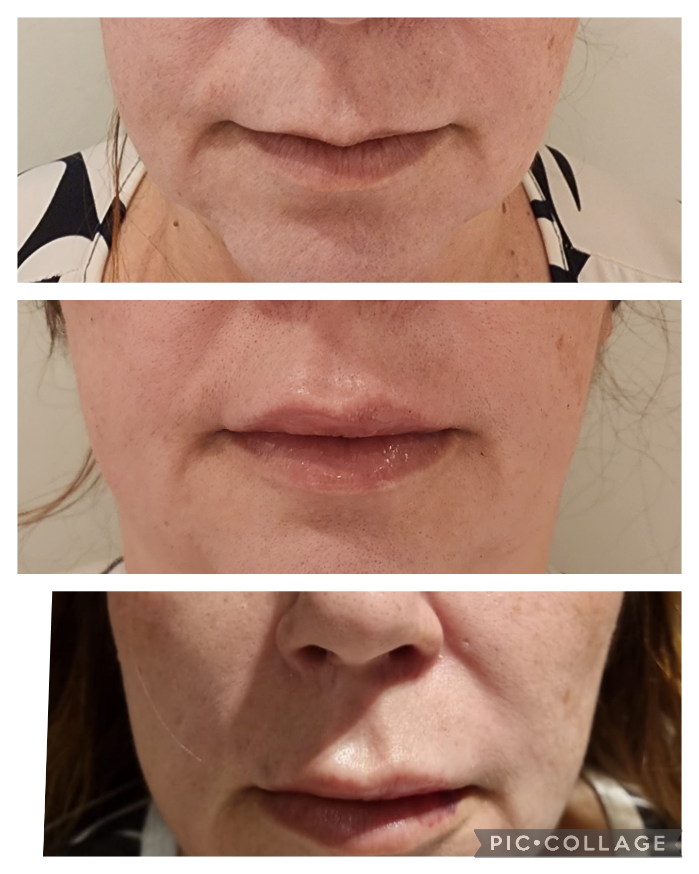 Preenchimento Labial - resultado 3