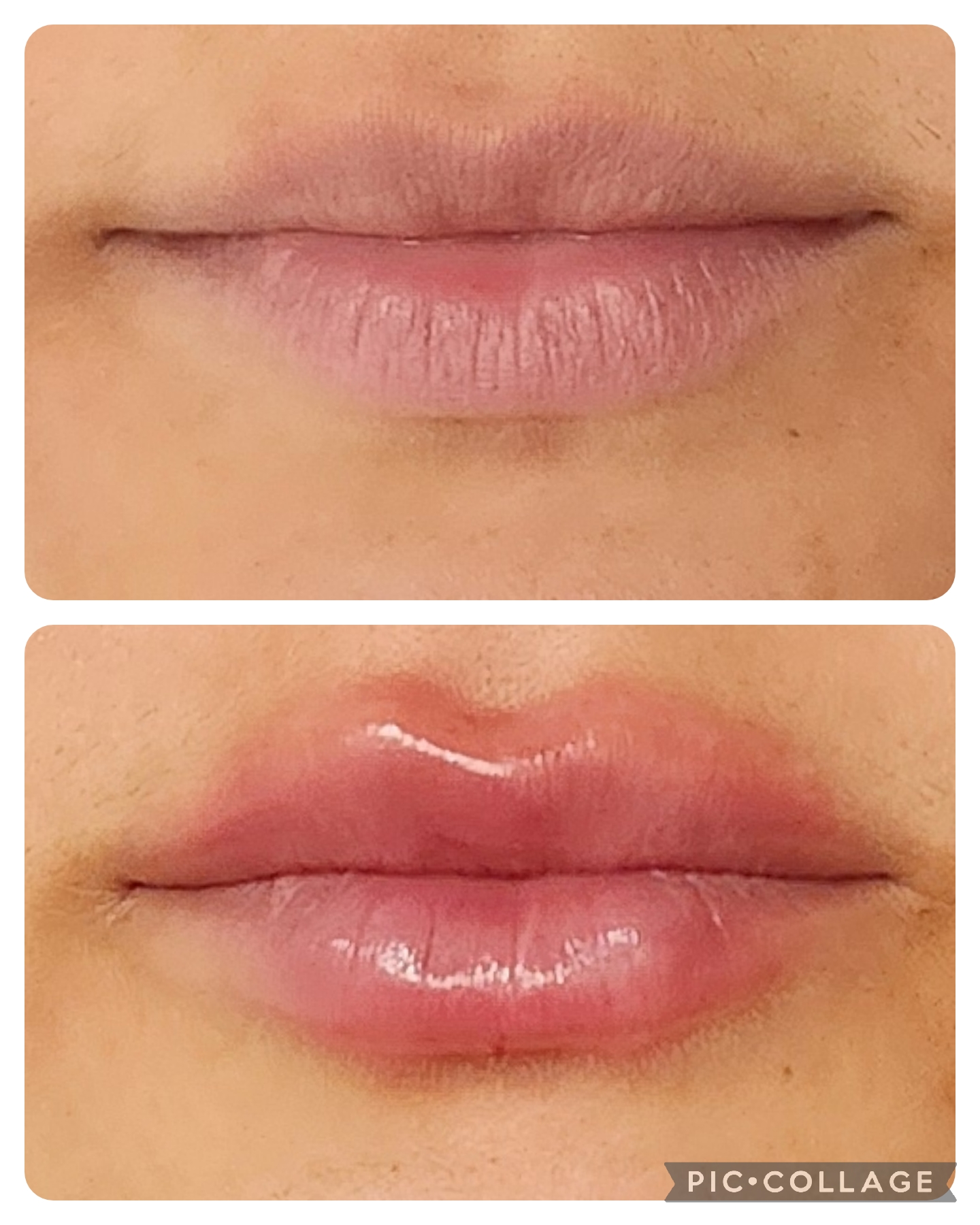 Preenchimento Labial - resultado 4
