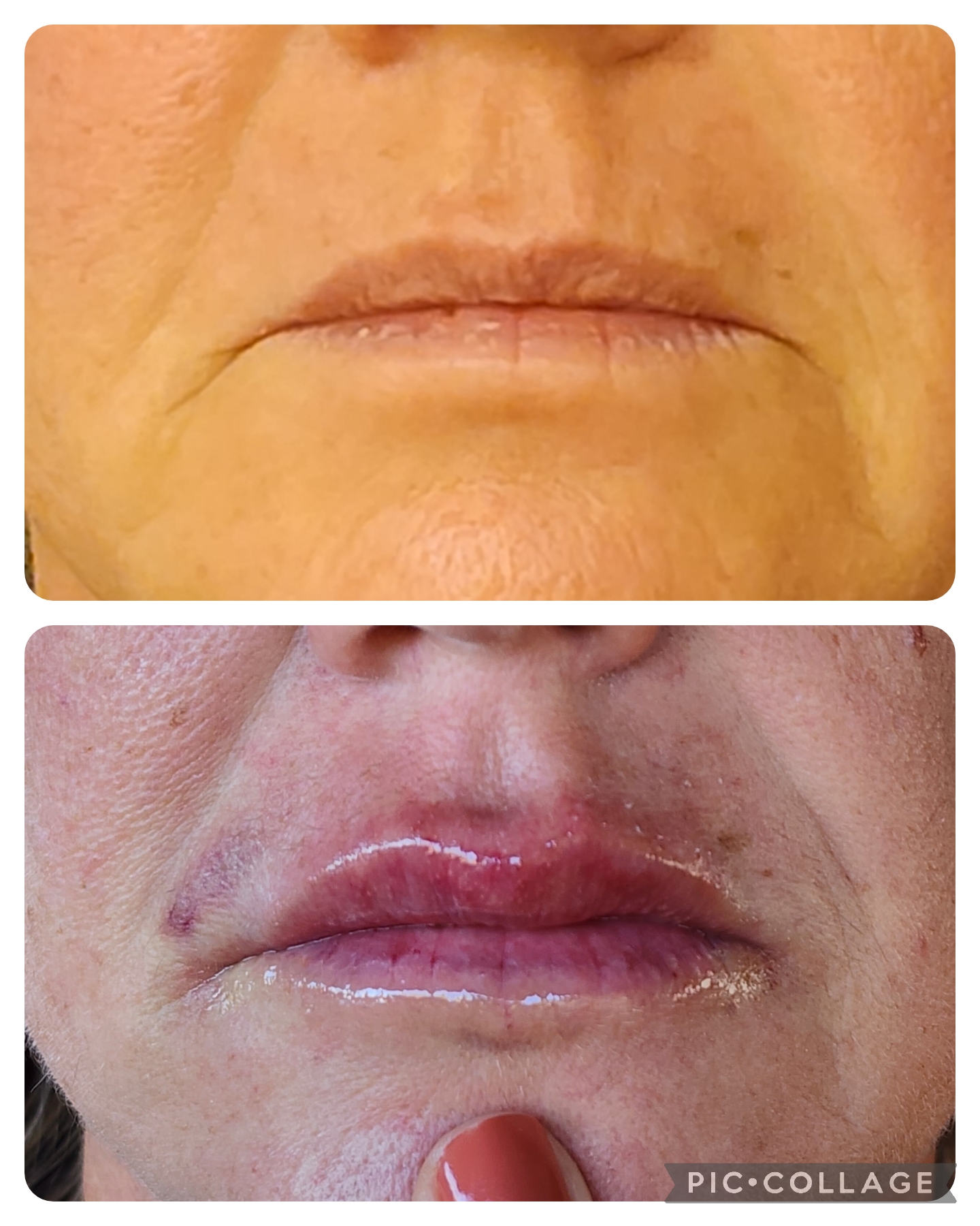 Preenchimento Labial - resultado 5
