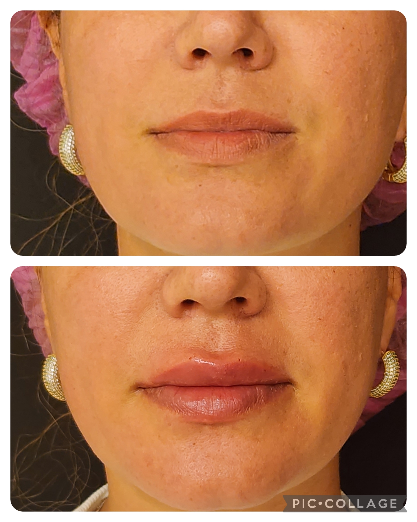 Preenchimento Labial - resultado 6