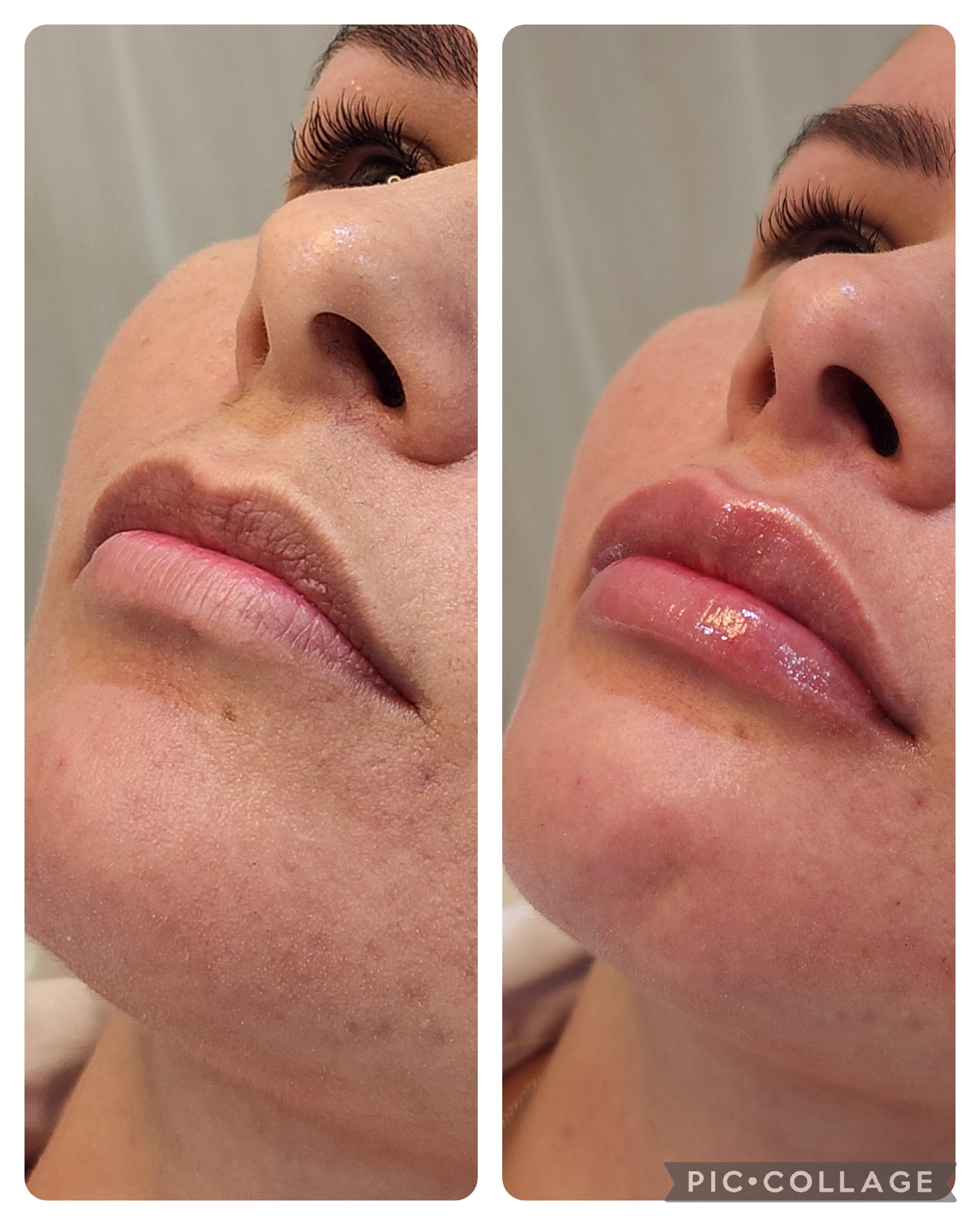 Preenchimento Labial - resultado 7