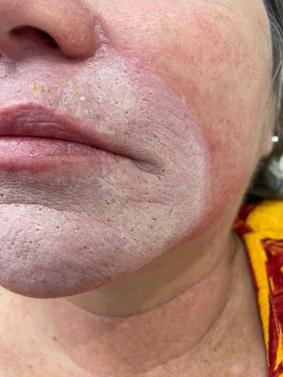 Peeling Químico - resultado 2