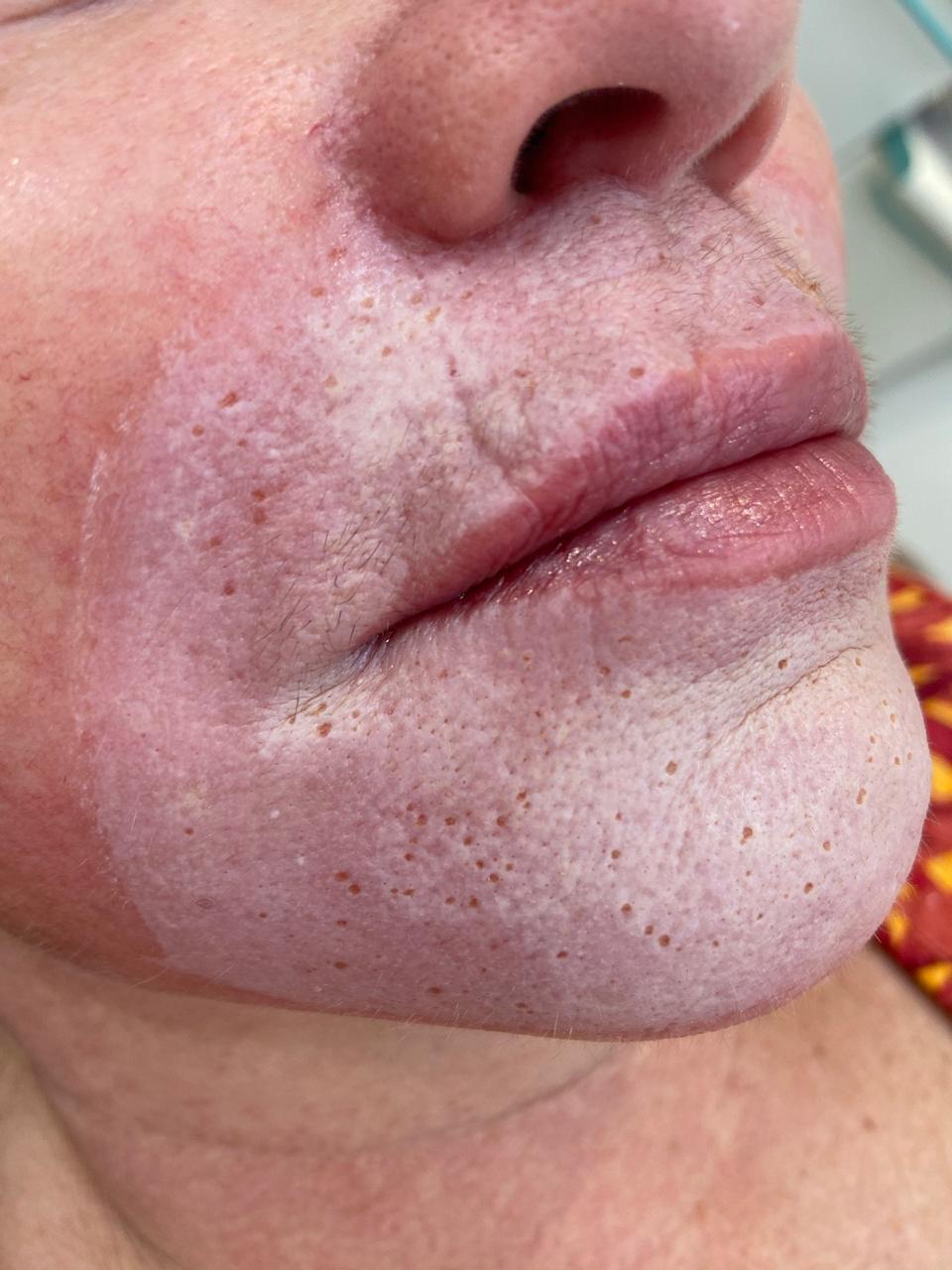 Peeling Químico - resultado 3