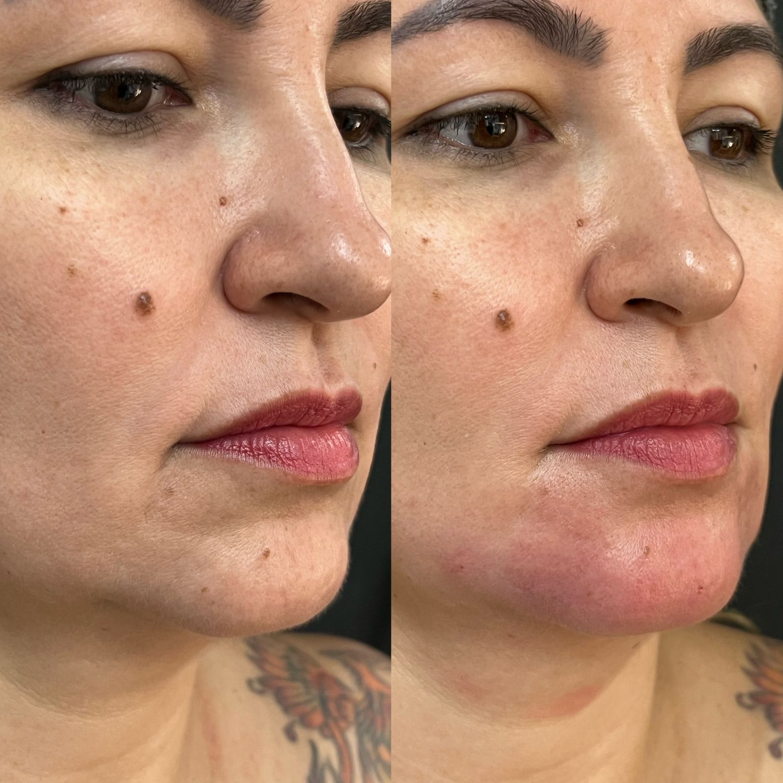 Preenchimento Labial - resultado 8