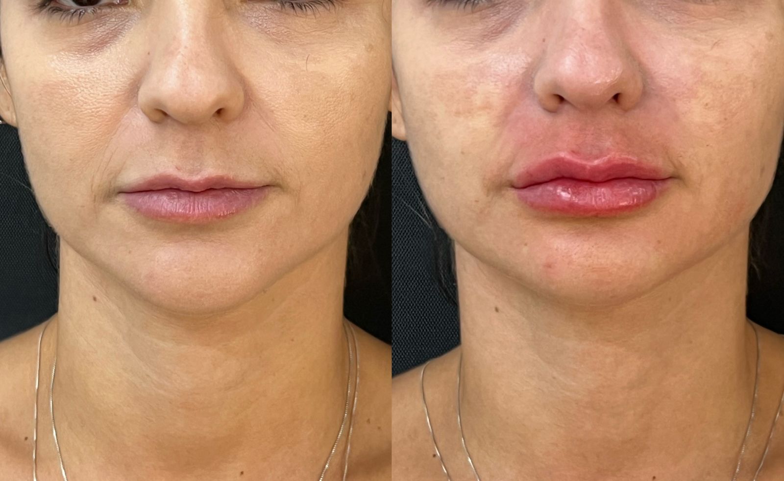 Preenchimento Labial - resultado 9