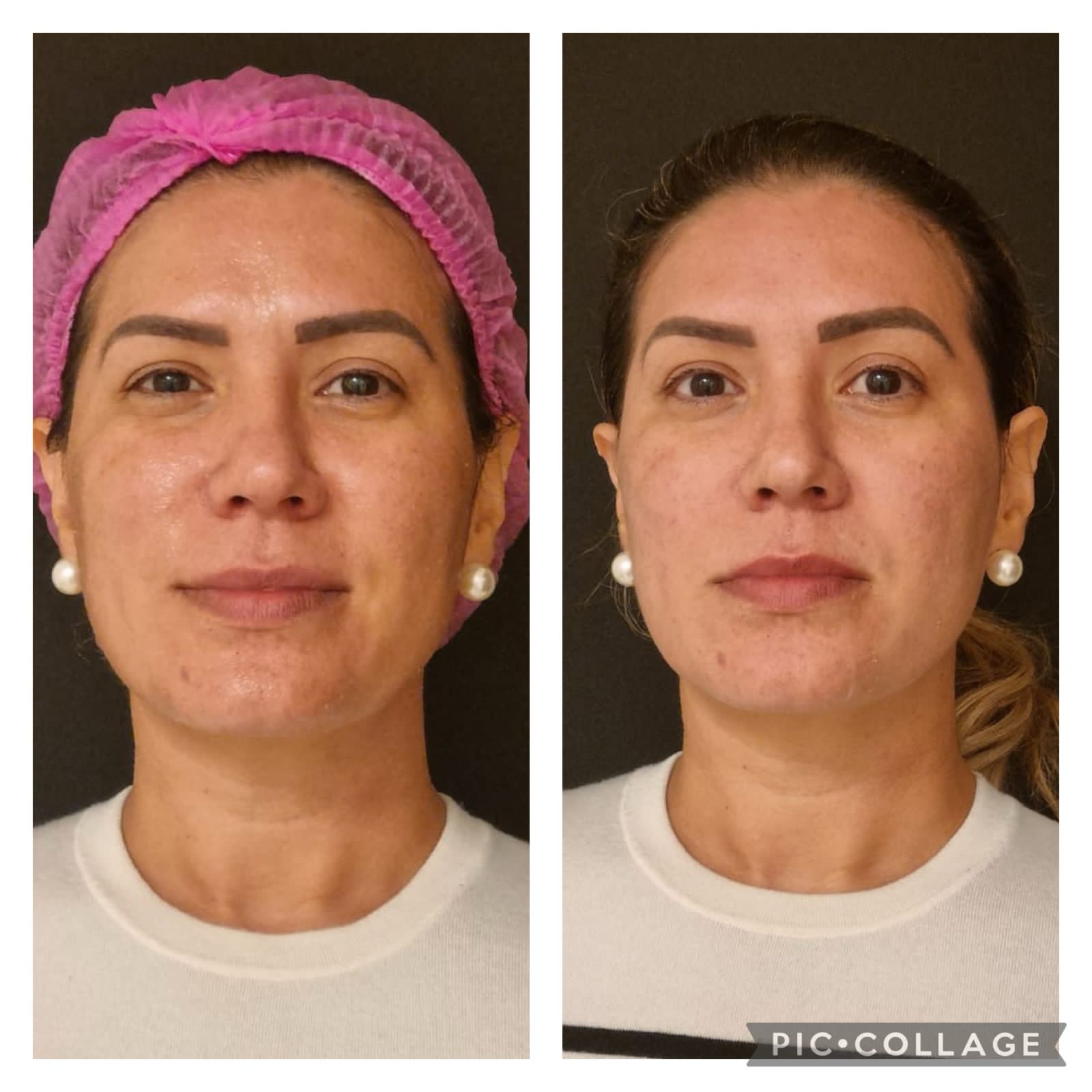 Preenchimento Labial - resultado 10