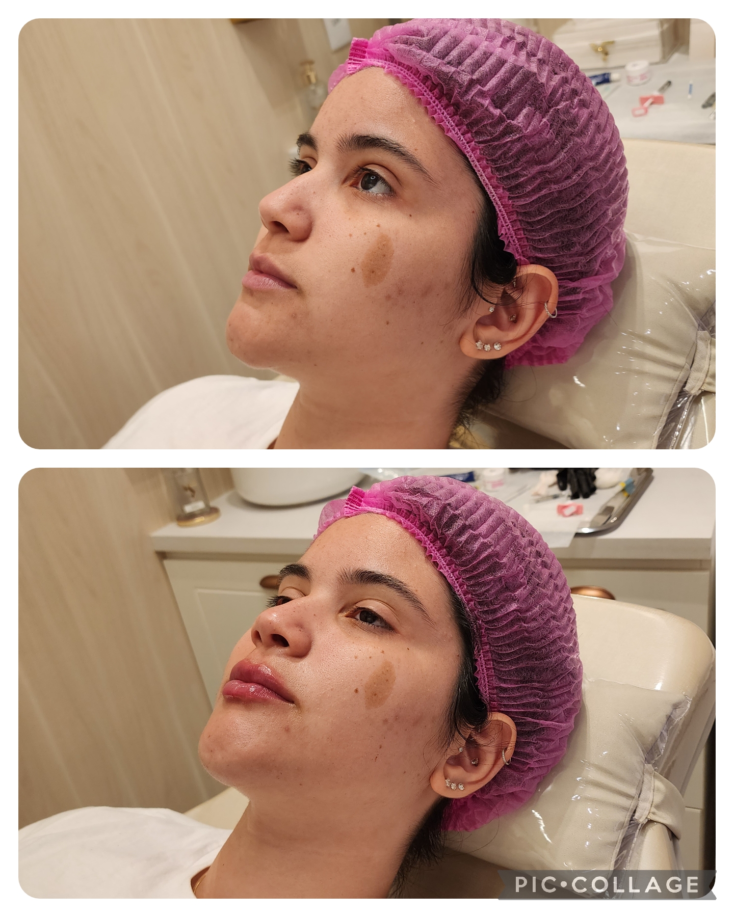 Resultado real de Preenchimento Labial — Dra. Vanucia Lage