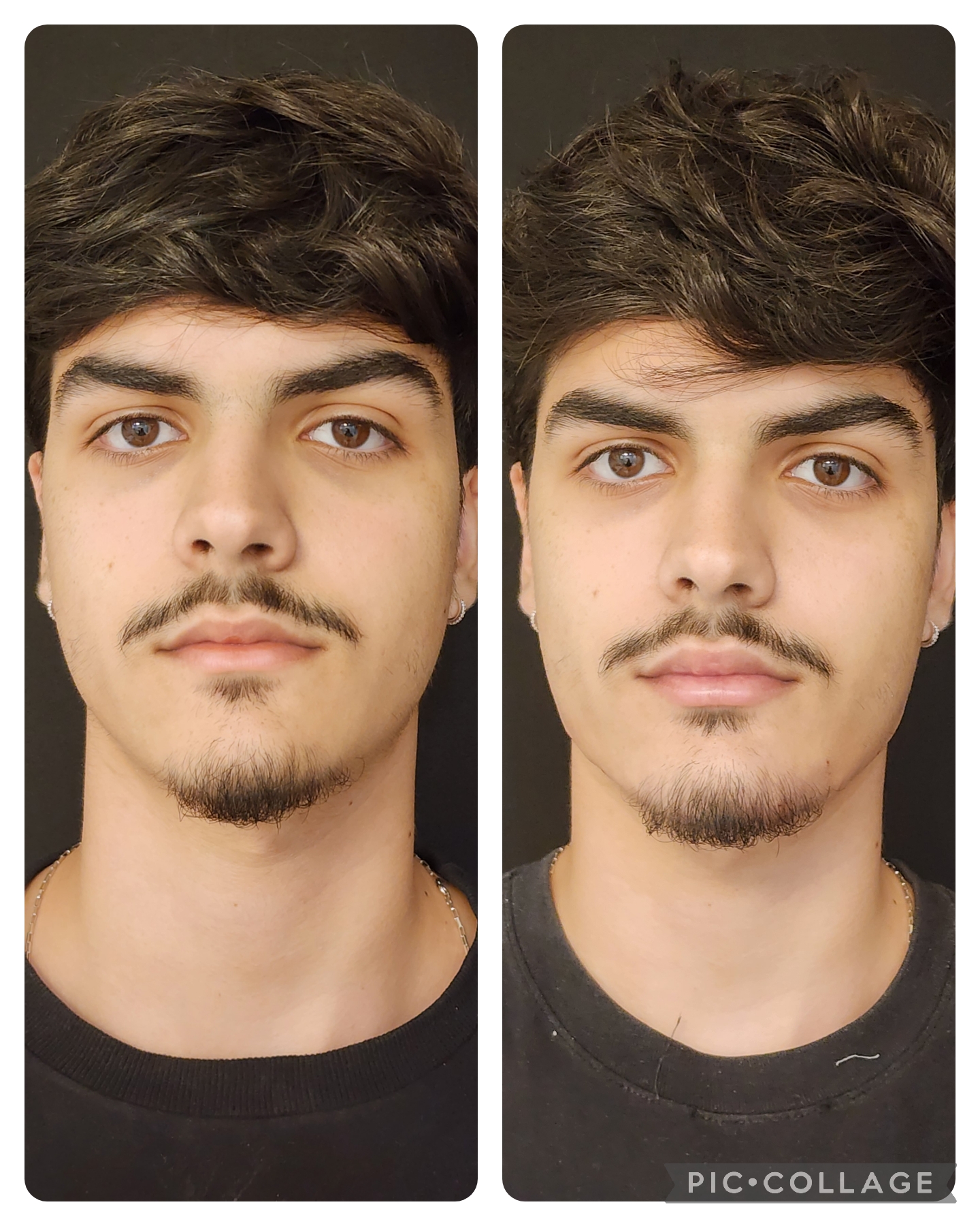 Resultado real de Preenchimento Labial — Dra. Vanucia Lage
