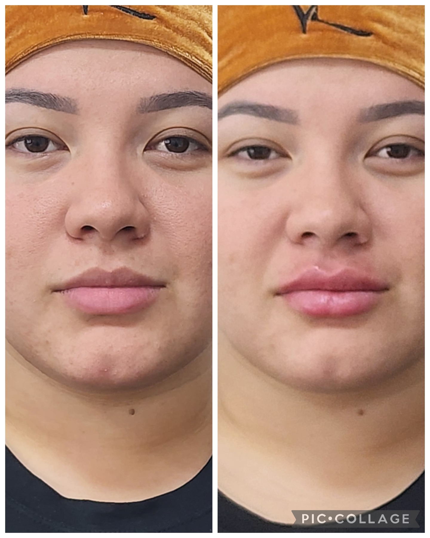 Resultado real de Preenchimento Labial — Dra. Vanucia Lage