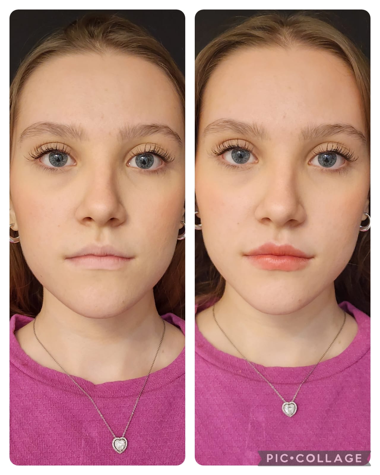 Resultado real de Preenchimento Labial — Dra. Vanucia Lage