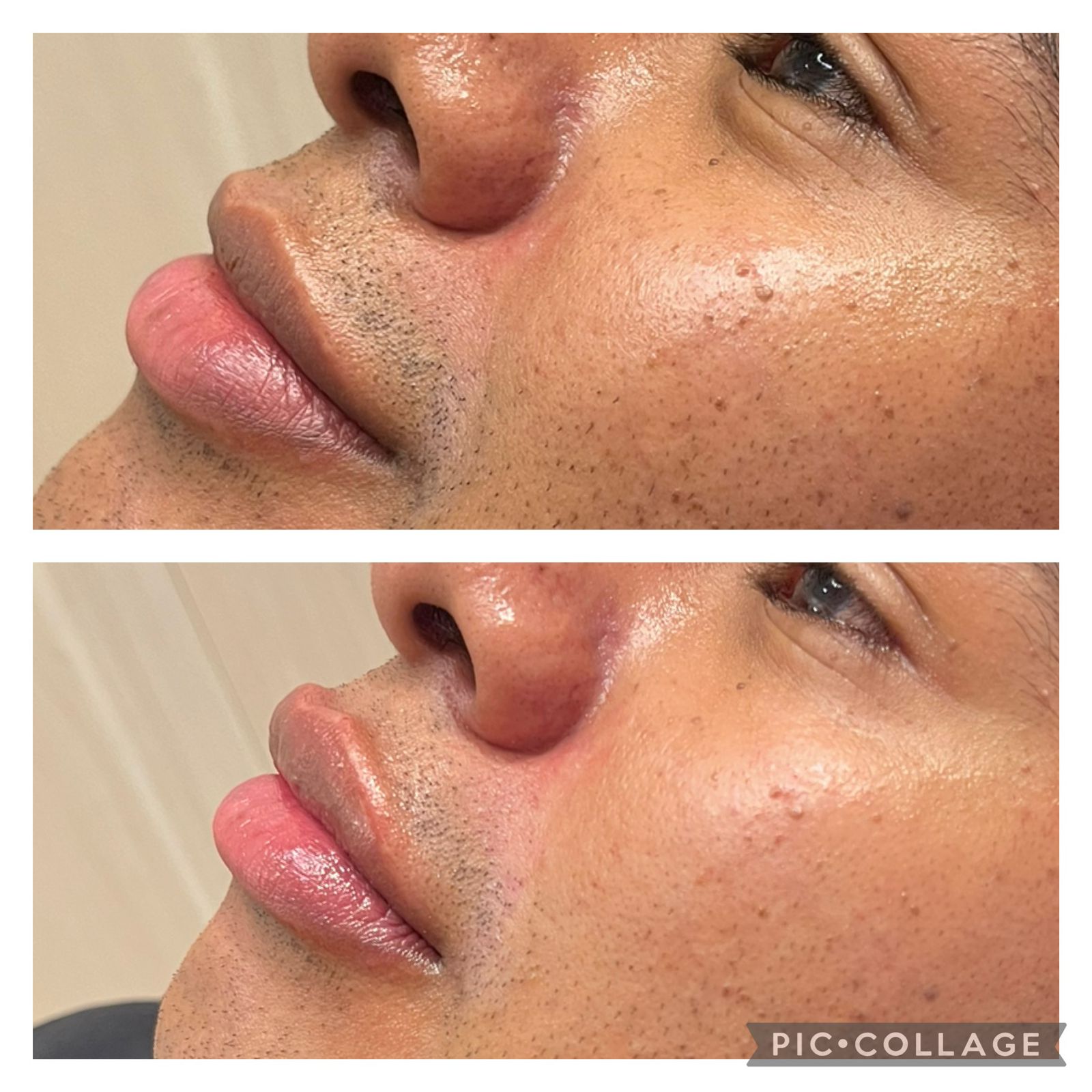 Resultado real de Preenchimento Labial — Dra. Vanucia Lage