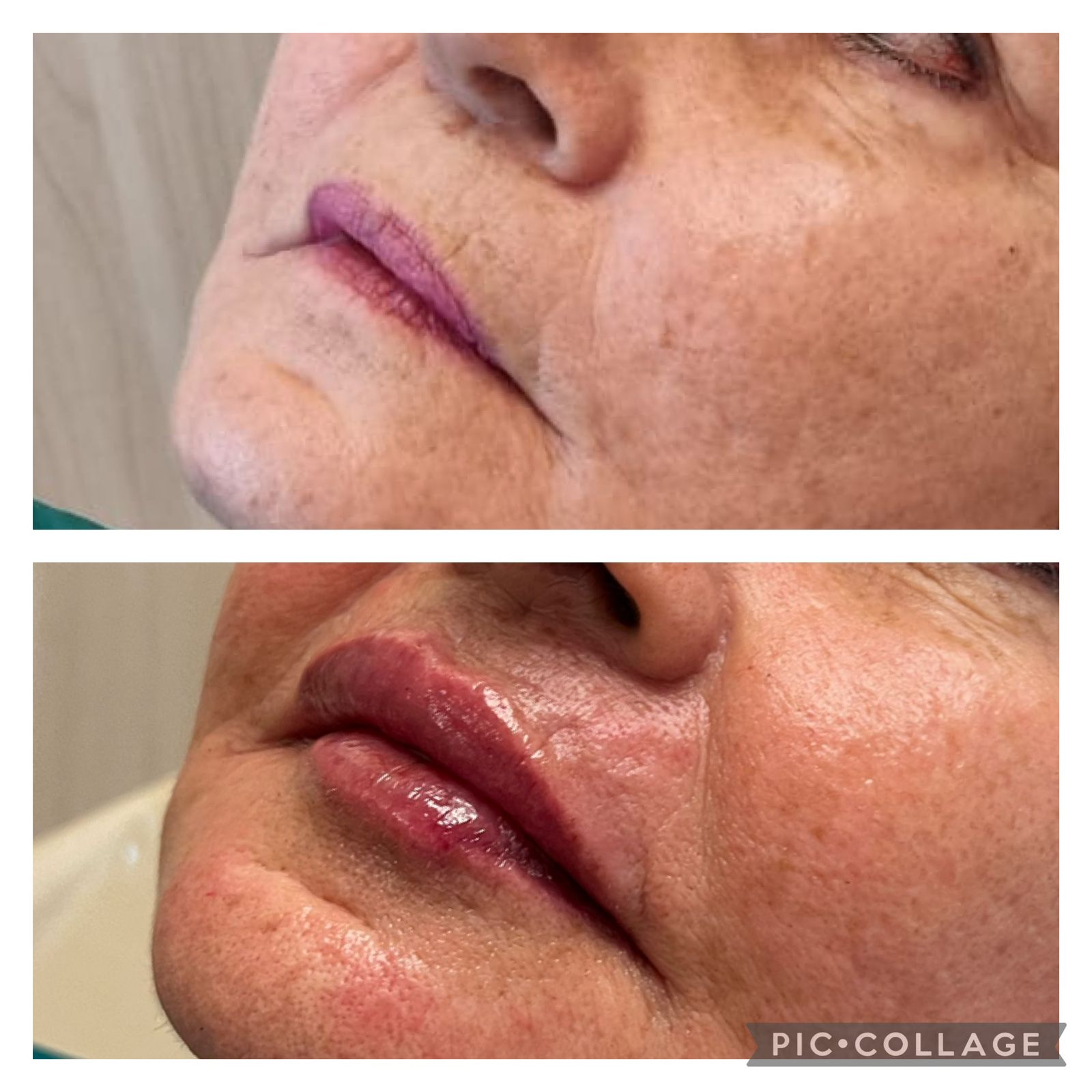 Resultado real de Preenchimento Labial — Dra. Vanucia Lage