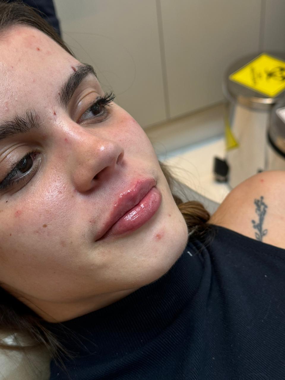 Resultado real de Preenchimento Labial — Dra. Vanucia Lage