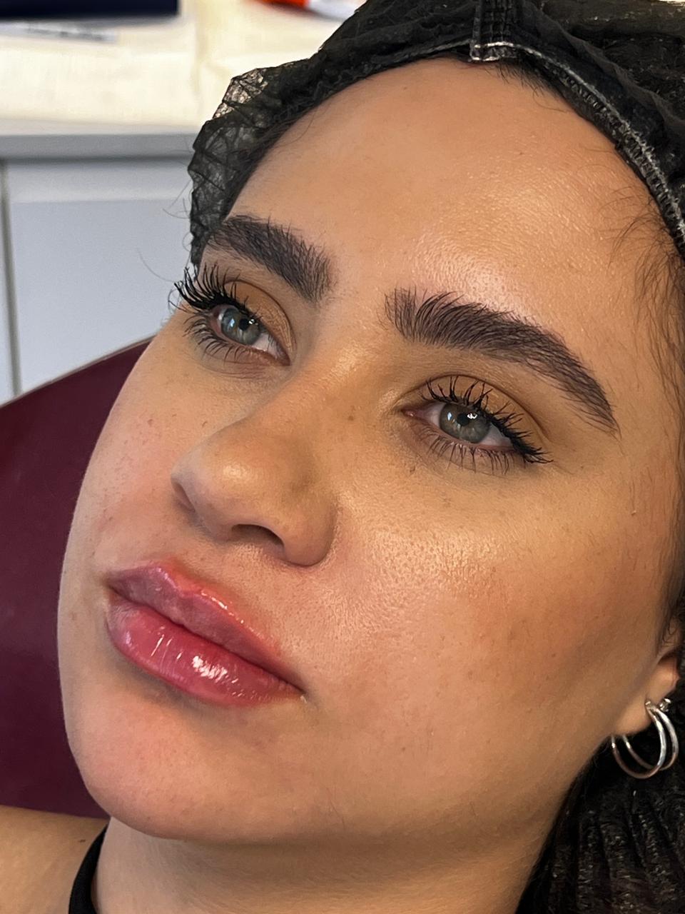 Resultado real de Preenchimento Labial — Dra. Vanucia Lage