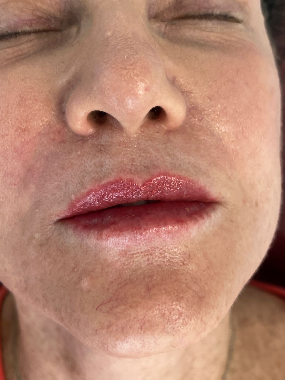 Resultado real de Preenchimento Labial — Dra. Vanucia Lage