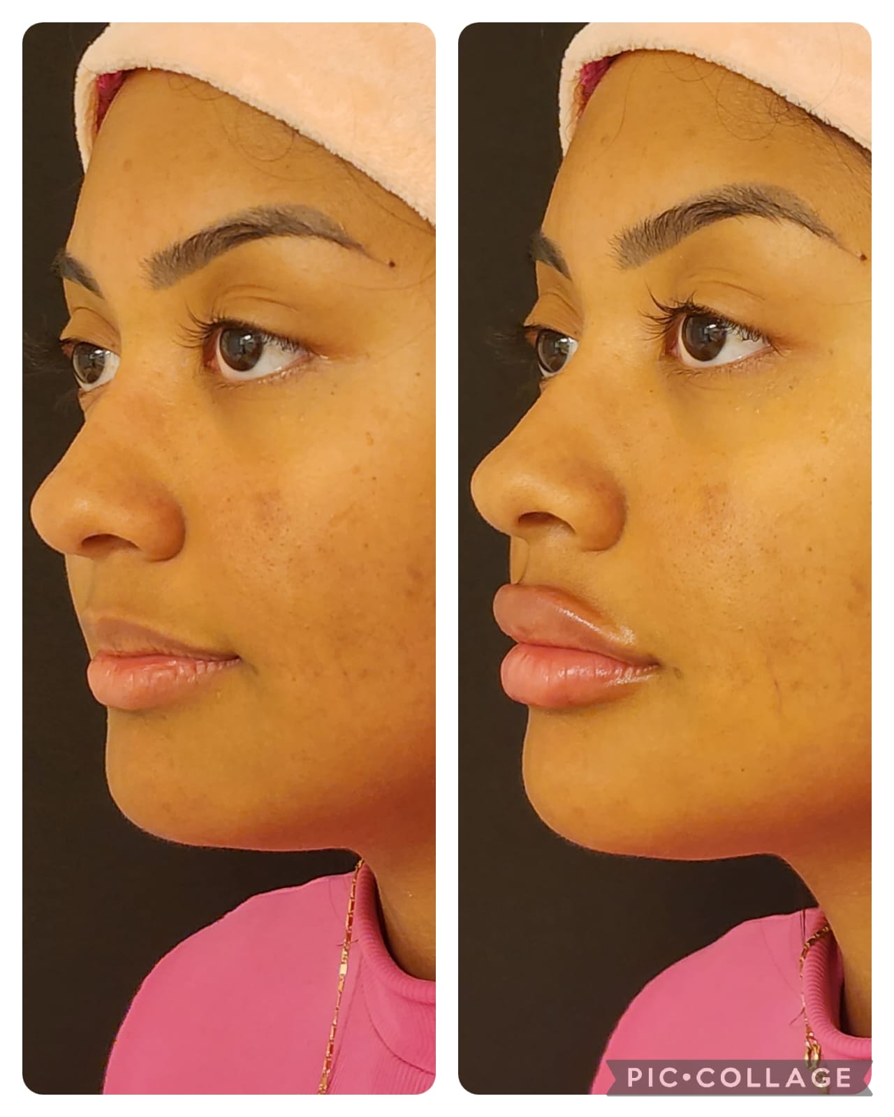 Resultado real de Preenchimento Labial — Dra. Vanucia Lage