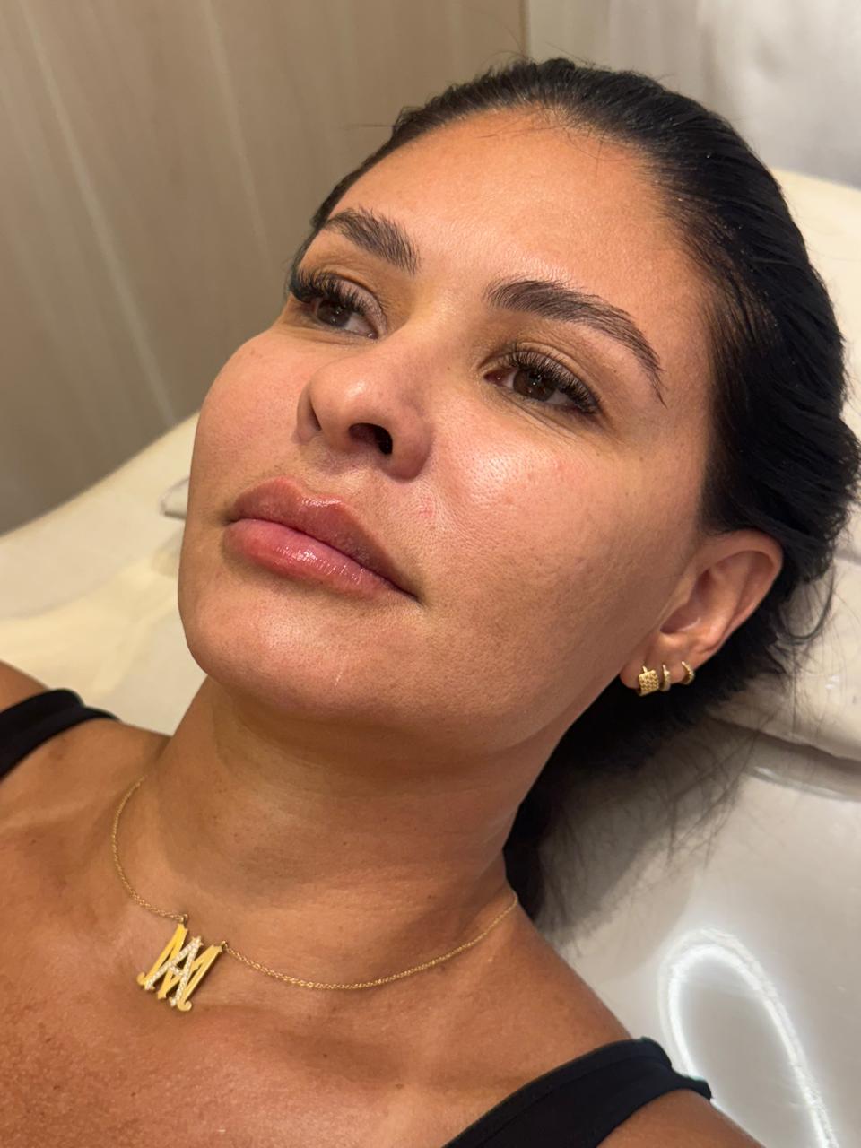 Resultado real de Preenchimento Labial — Dra. Vanucia Lage