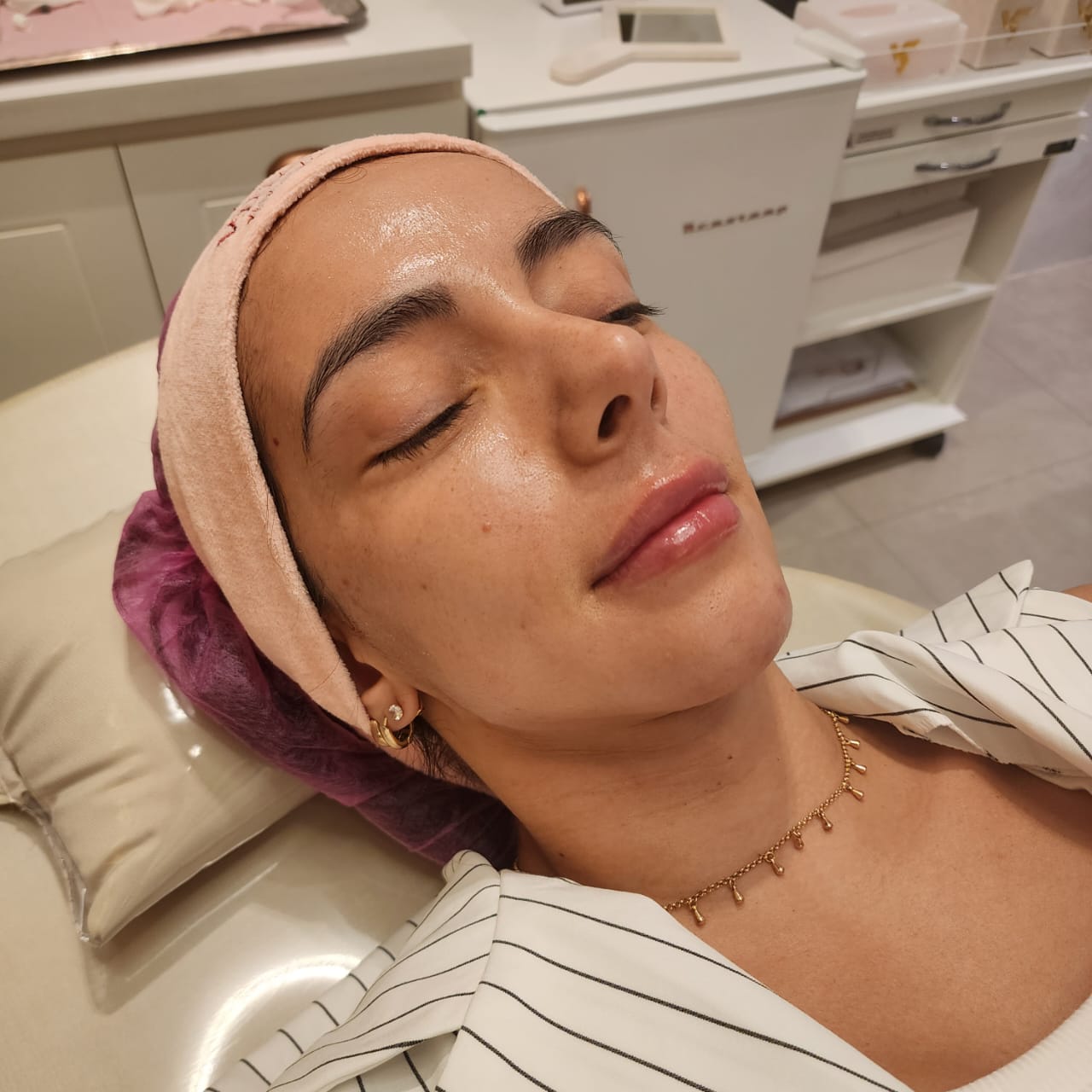Resultado real de Preenchimento Labial — Dra. Vanucia Lage