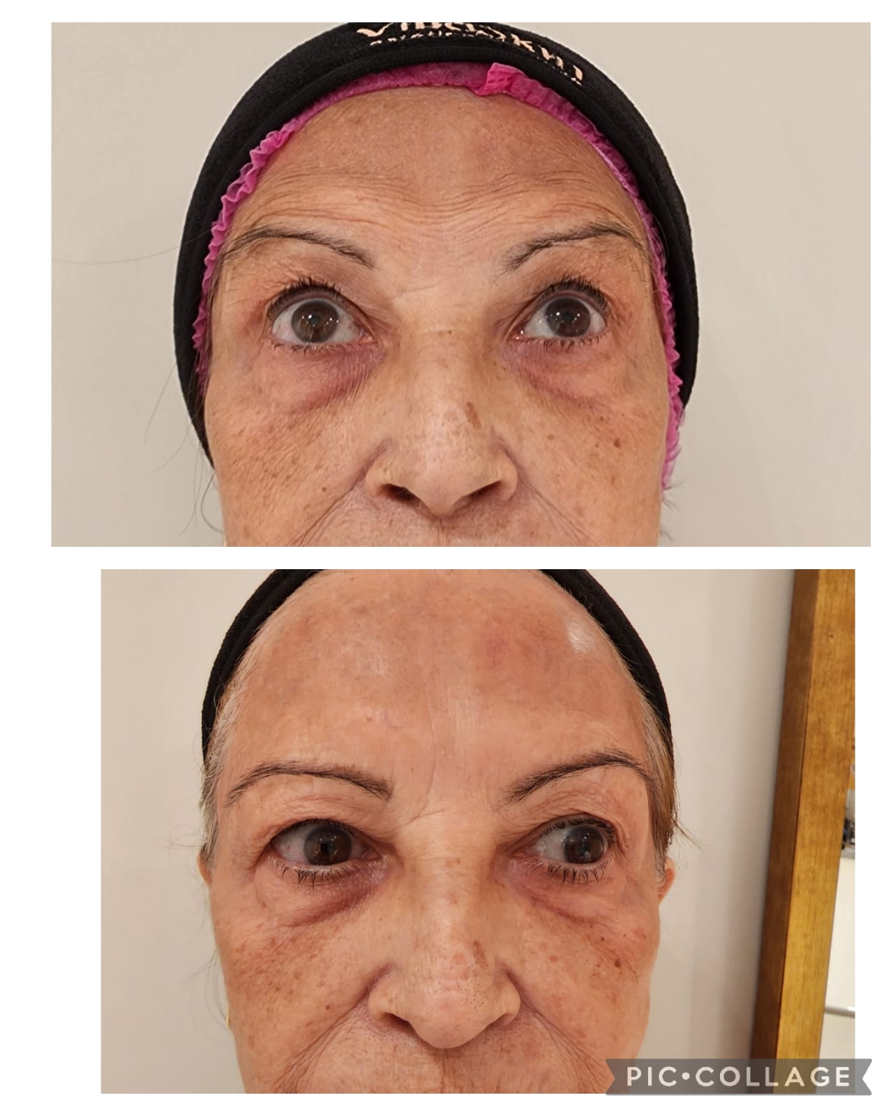 Resultado real de Toxina Botulínica — Dra. Vanucia Lage