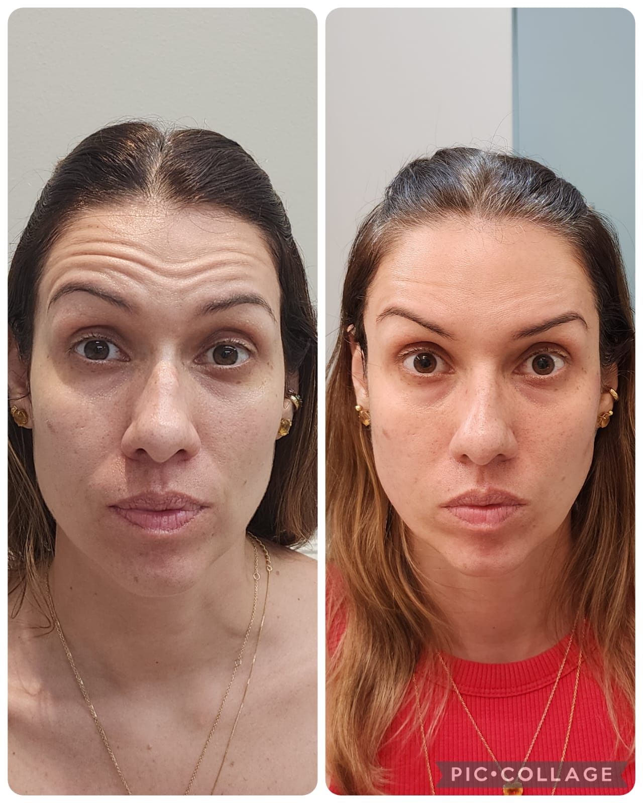 Resultado real de Toxina Botulínica — Dra. Vanucia Lage