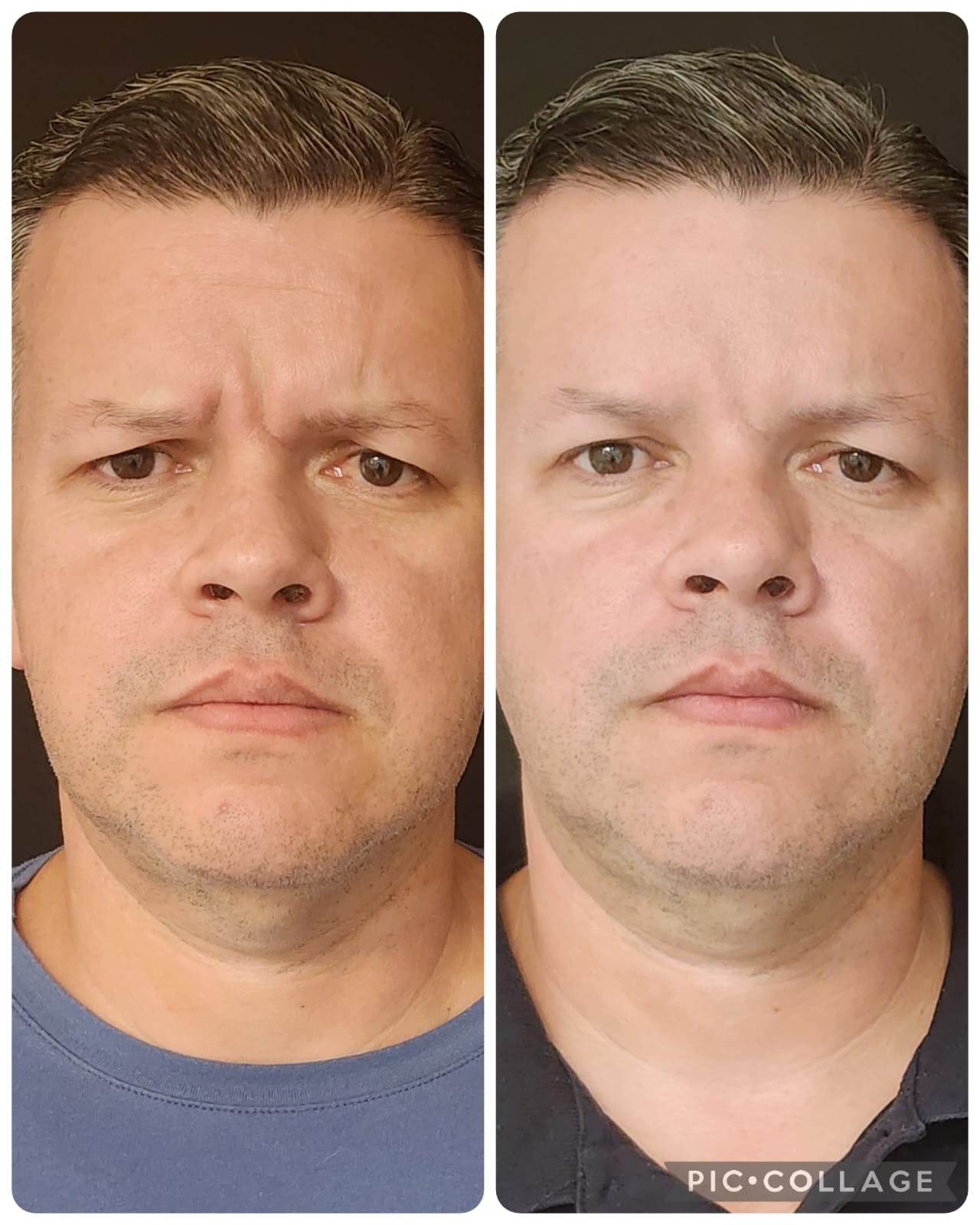 Resultado real de Toxina Botulínica — Dra. Vanucia Lage