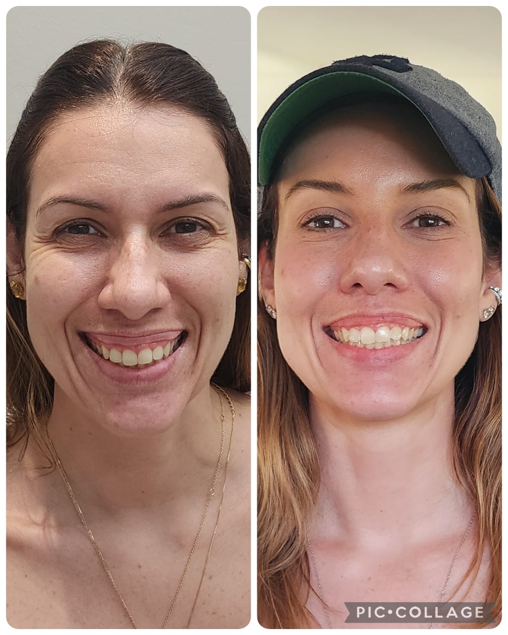 Resultado real de Toxina Botulínica — Dra. Vanucia Lage