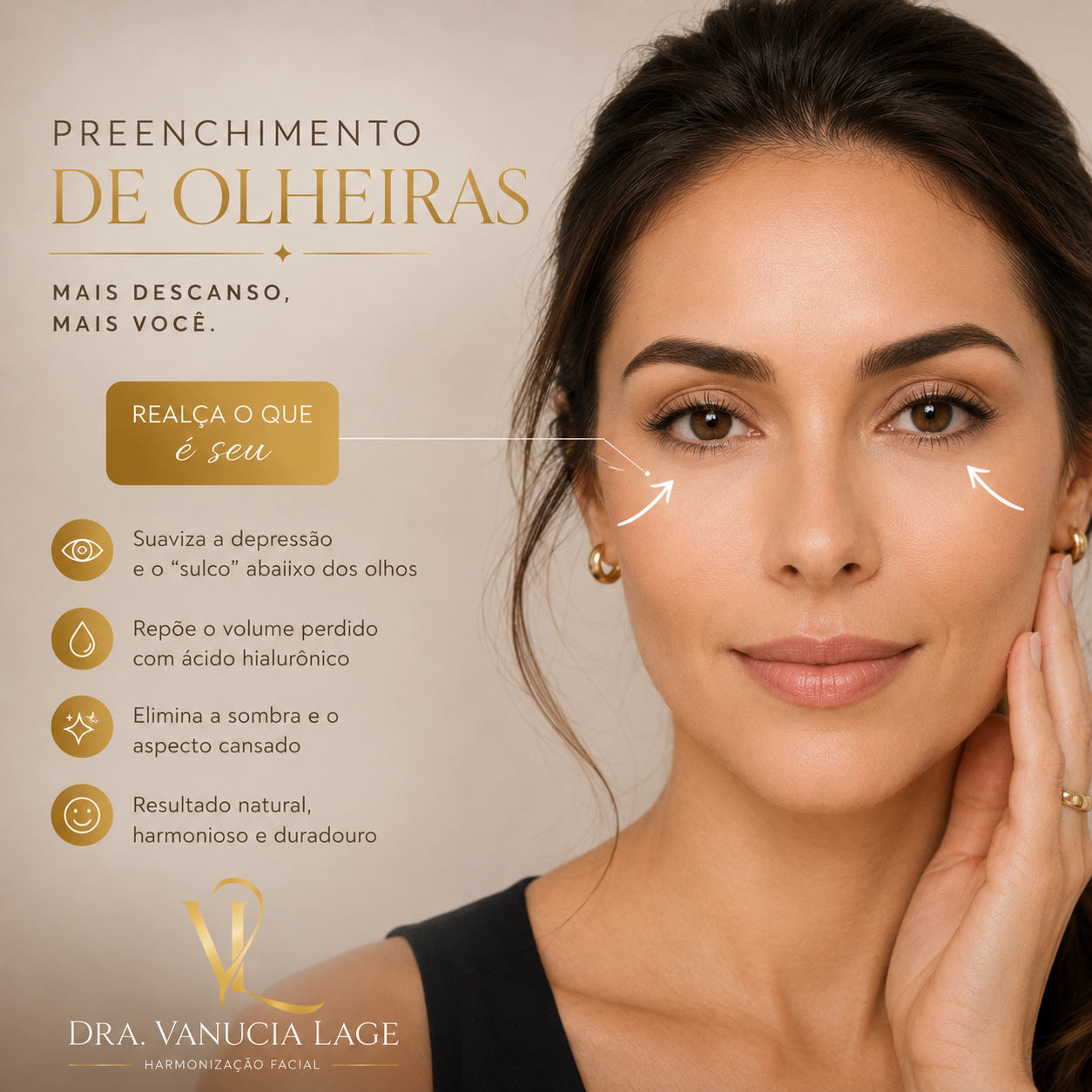 Procedimento de Preenchimento de Olheiras — Dra. Vanucia Lage