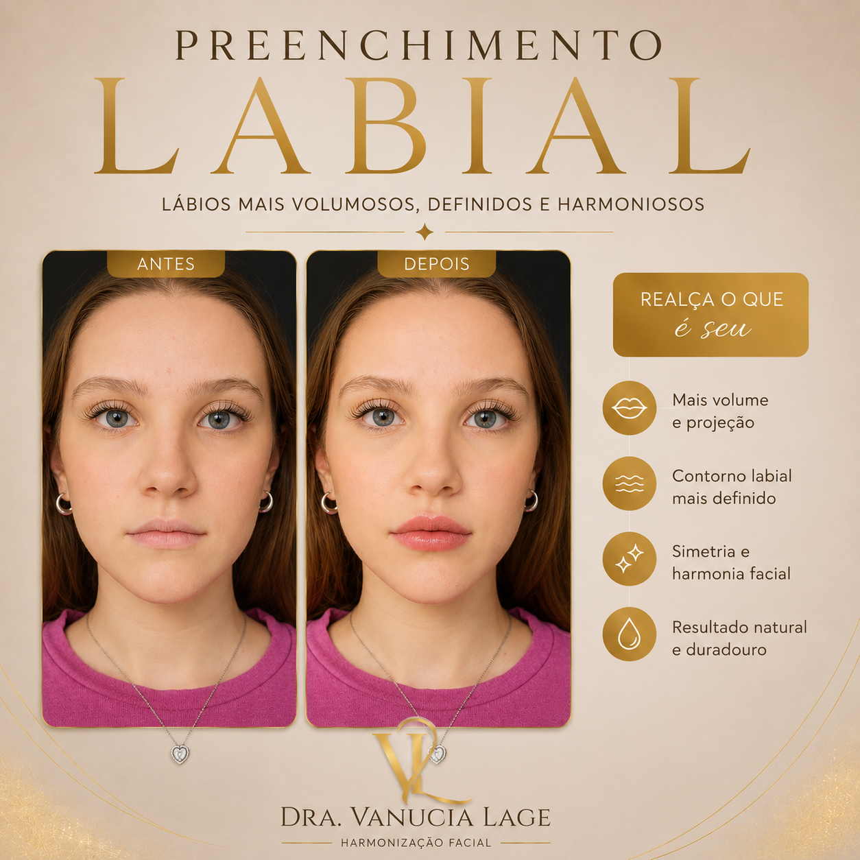 Procedimento de Preenchimento Labial — Dra. Vanucia Lage