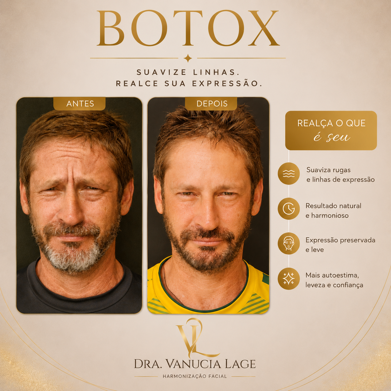 Procedimento de Toxina Botulínica — Dra. Vanucia Lage